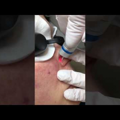 Удаление сосудов диодным лазером на лице безболезненно - Процедура