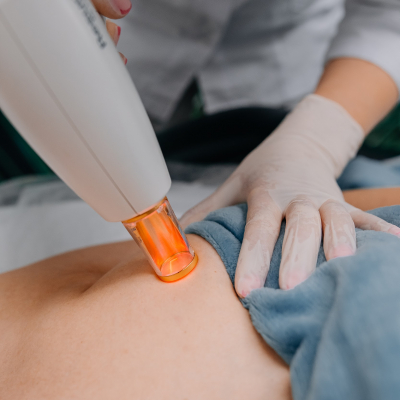 Видалення шрамів Lumenis M22