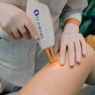 Видалення рубців Lumenis M22