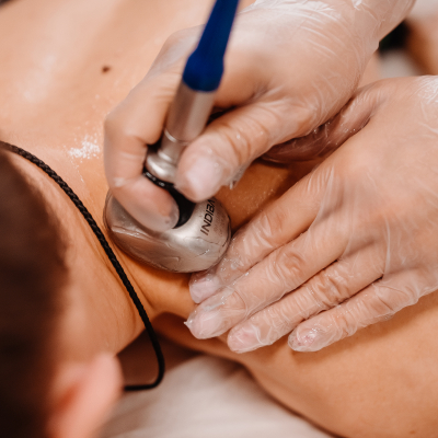 RF лифтинг спины