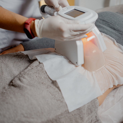 Кріоліполіз живота