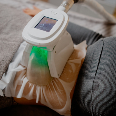 Кріоліполіз процедура