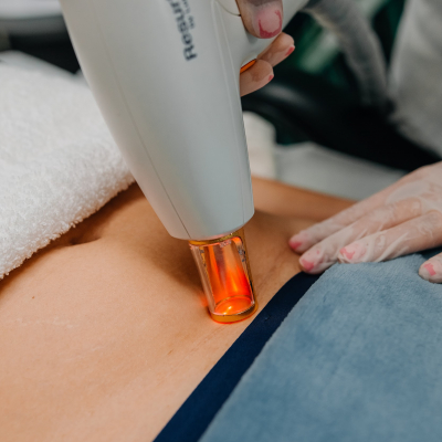 Видалення шрамів Lumenis M22