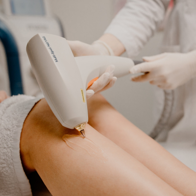 Видалення судин на ногах Lumenis M22