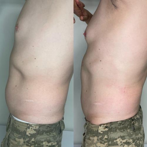 Розщеплення жиру на животі у чоловіка після процедури RF ліфтинг INDIBA
